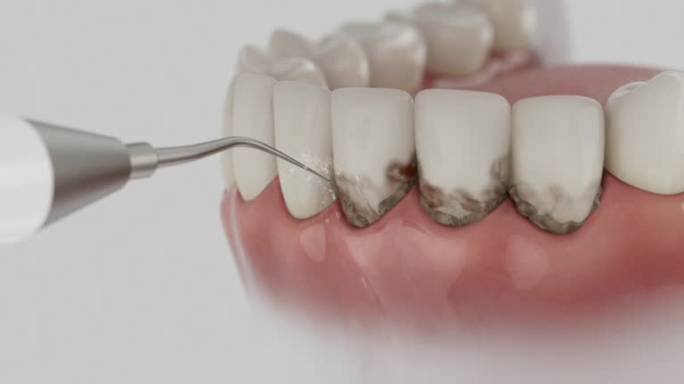 Trusted Wisdom Tooth Removal service in Mission, SD - Dentist Open Now